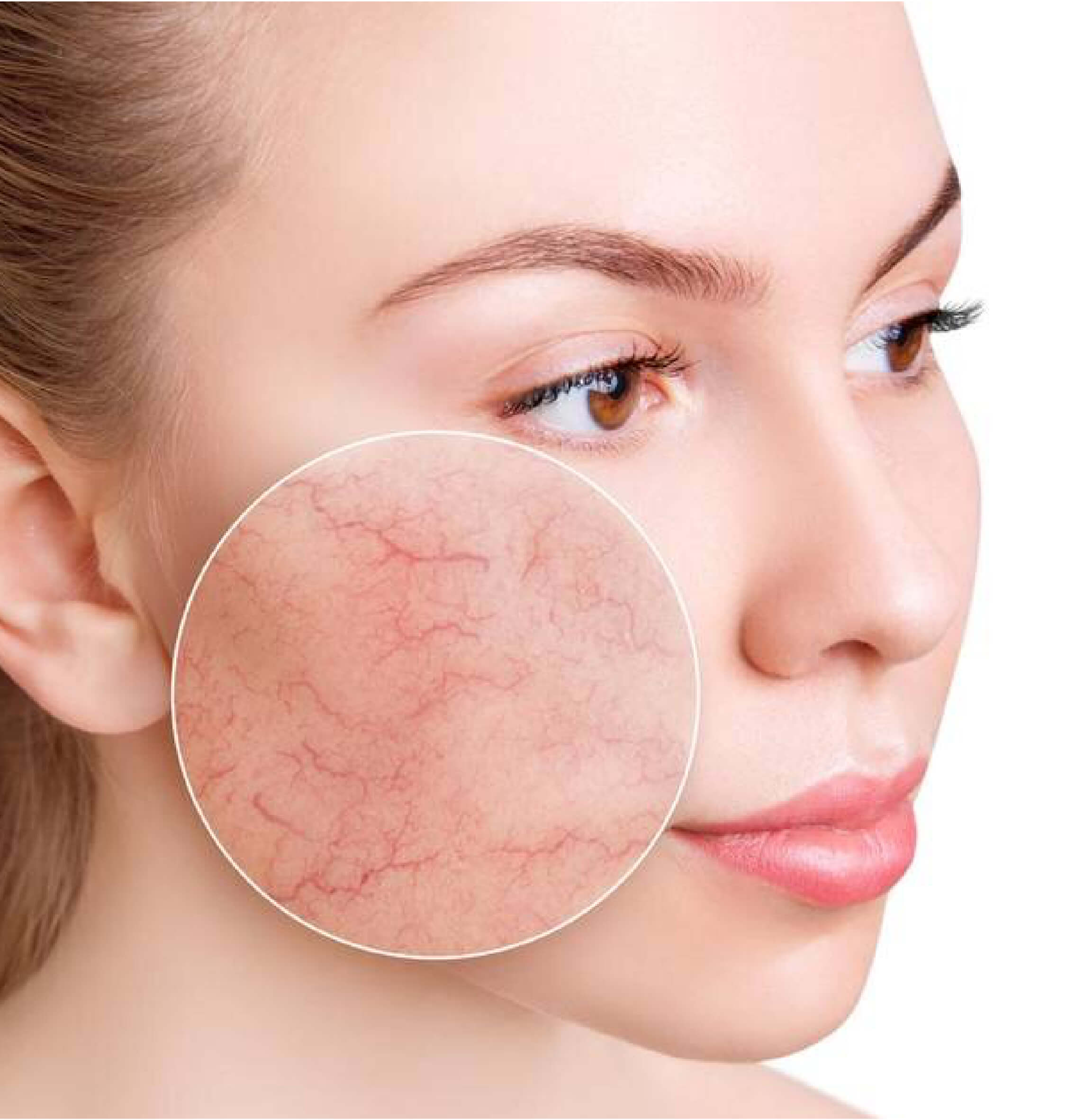 Peau présentant des rougeurs et de la couperose, une condition pouvant être améliorée grâce au traitement IPL en clinique esthétique