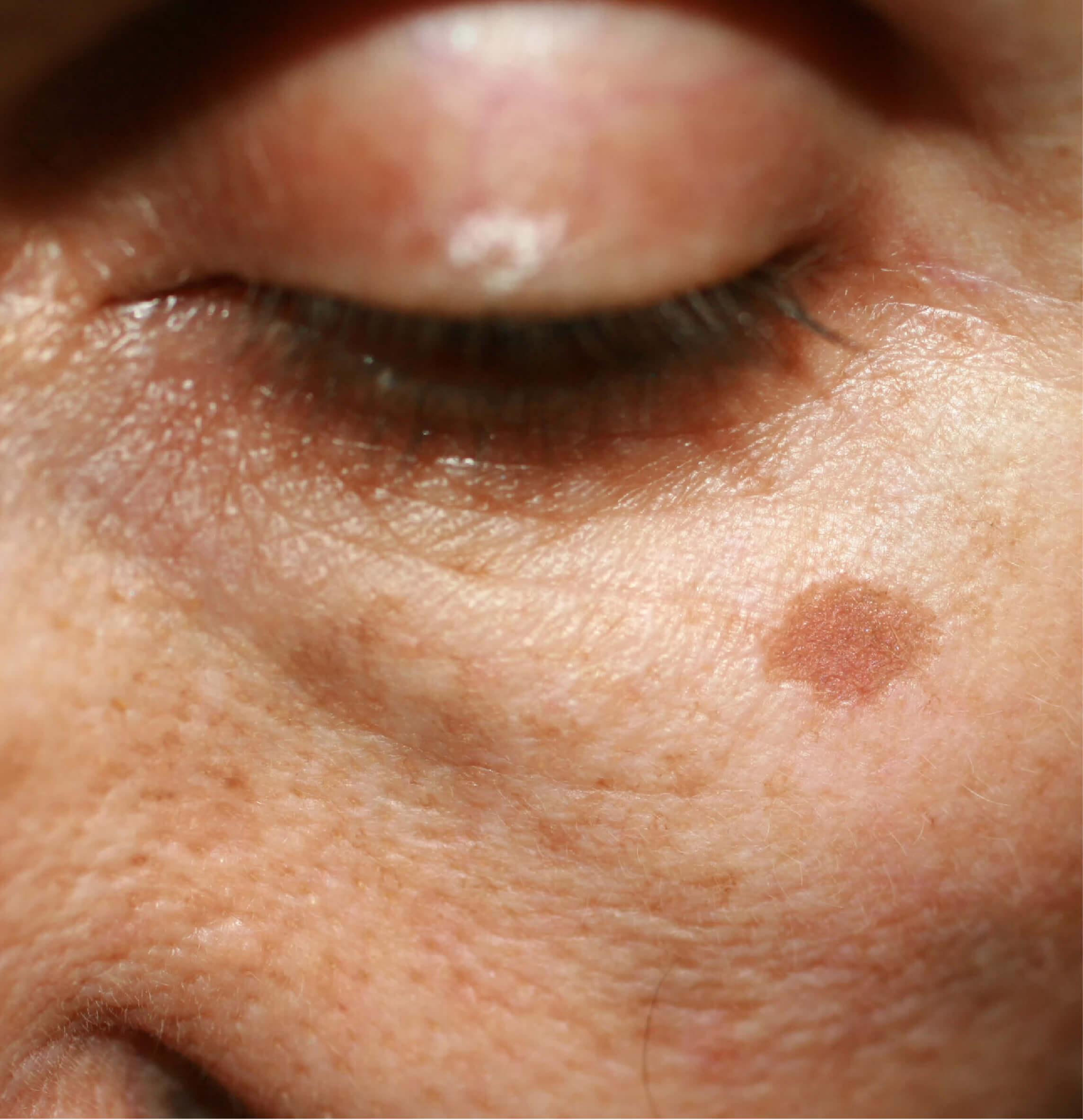 Peau avec une tache pigmentaire et des signes de vieillissement, idéale pour un traitement IPL de photorajeunissement en clinique esthétique