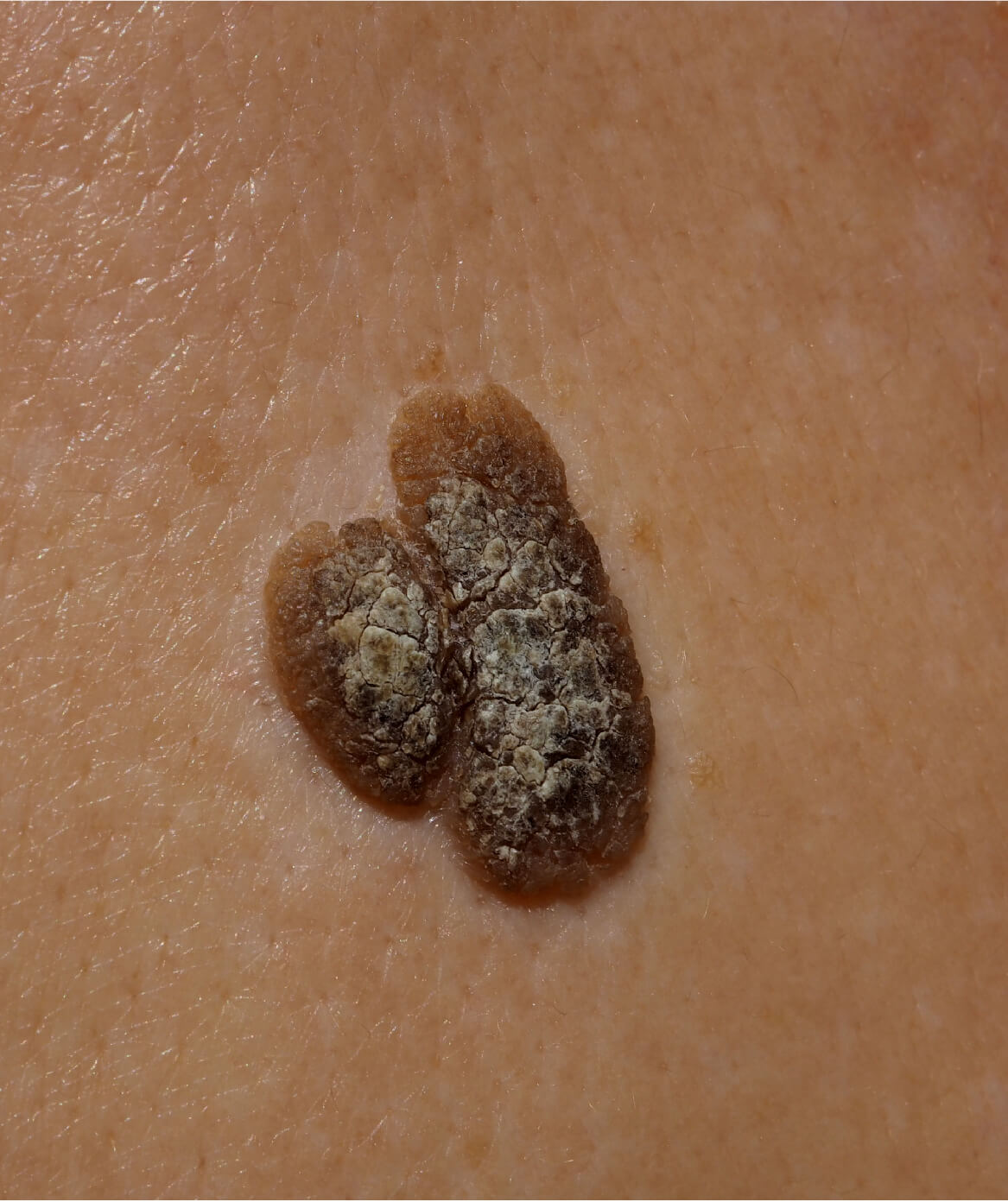 Image d’un kératome séborrhéique, une excroissance bénigne de la peau fréquemment observée chez les adultes, qui peut être traitée à la Clinique St-Laurent Médico-Esthétique.
