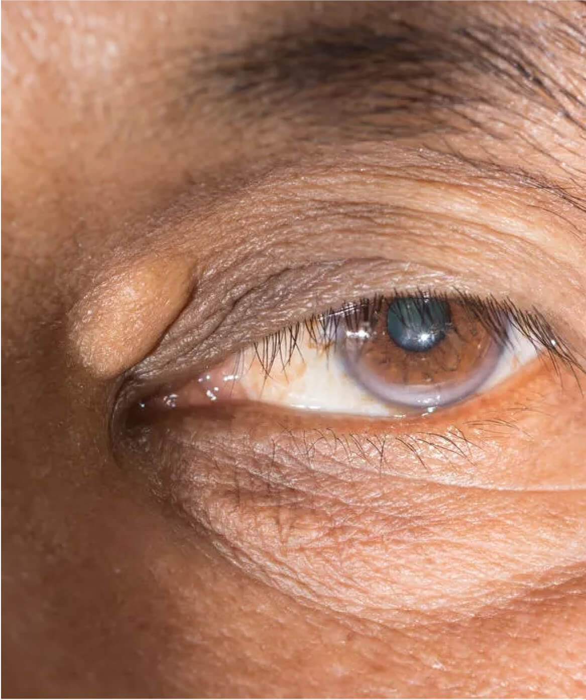 Image d’un xanthélasma situé près de l’œil, une excroissance bénigne de la peau qui peut être traitée à la Clinique St-Laurent Médico-Esthétique.