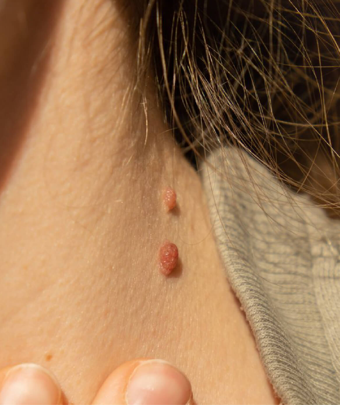 Image montrant deux acrochordons, excroissances cutanées bénignes qui peuvent être traitées à la Clinique St-Laurent Médico-Esthétique