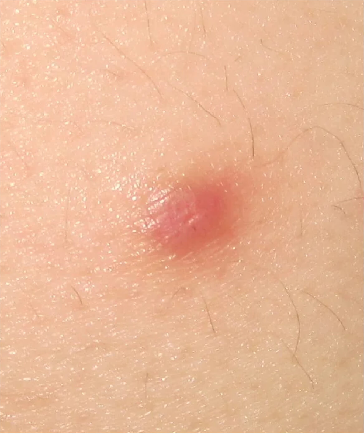 Image rapprochée d’un dermatofibrome, une excroissance cutanée bénigne qui peut être retirée lors de chirurgies mineures à la Clinique St-Laurent Médico-Esthétique.
