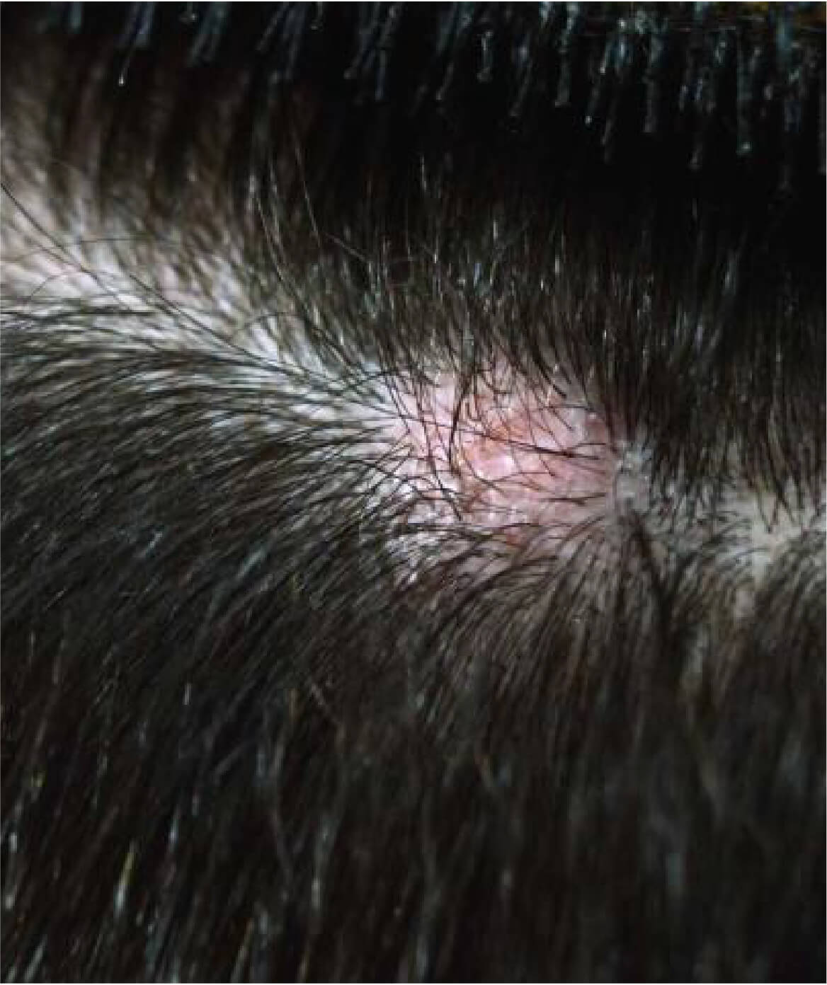 Image d’un kyste visible sur le cuir chevelu, illustrant un cas traité par chirurgie mineure à la Clinique St-Laurent Médico-Esthétique