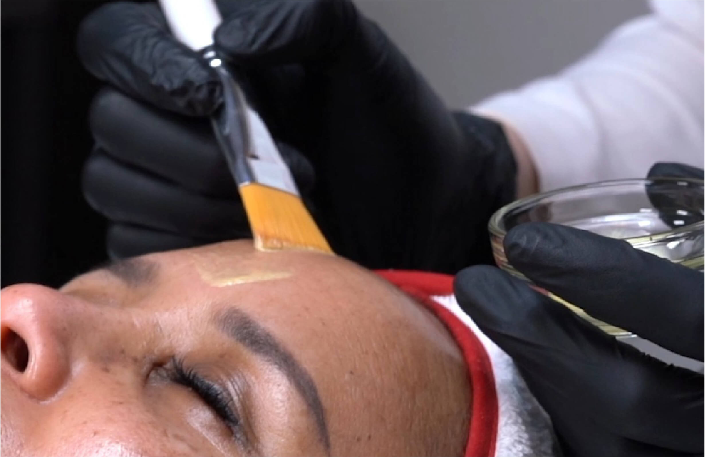 Application du Peeling Me-Line lors d’une séance en institut : soin professionnel pour réduire les taches pigmentaires, unifier le teint et illuminer la peau. Consultation et traitement réalisés par St-Laurent Médico-Esthétique