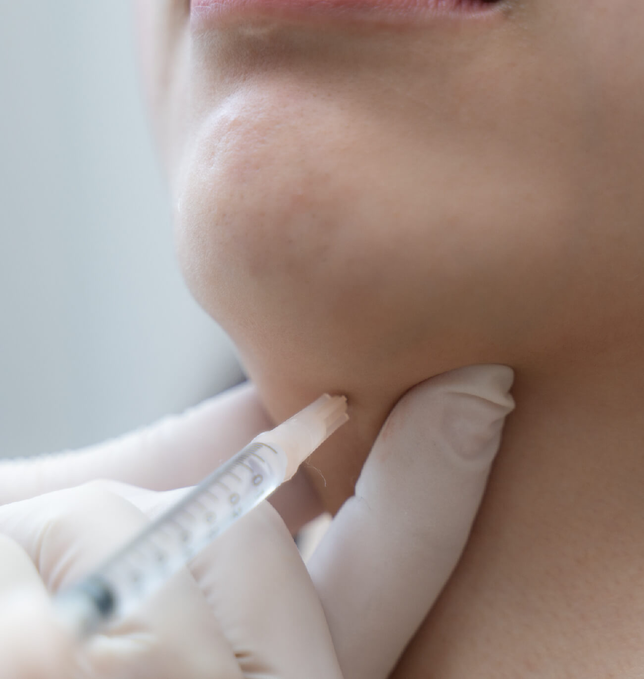 Injection sous le menton administrée par un professionnel portant des gants blancs, ciblant la graisse sous-mentonnière.