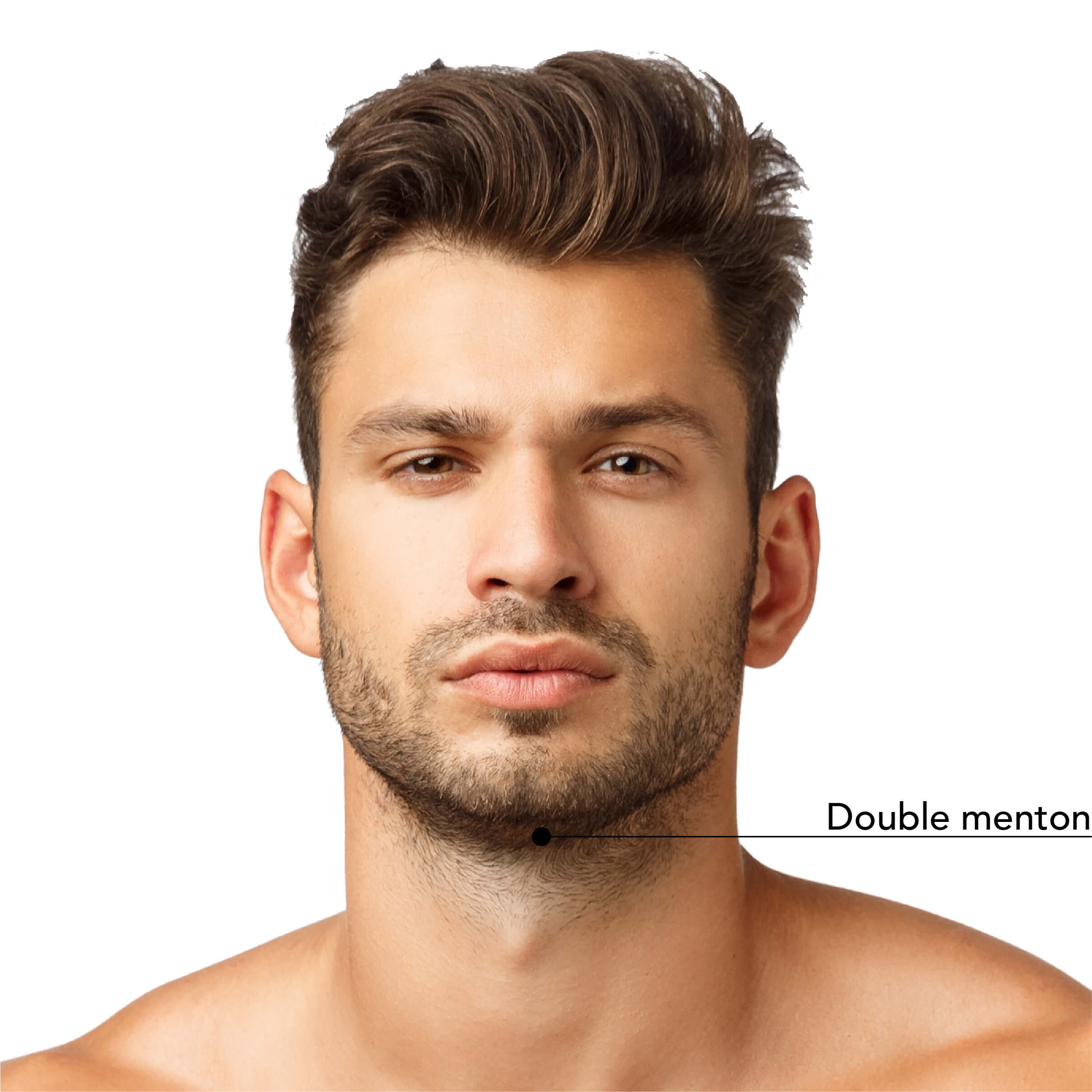 Homme montrant la zone du double menton ciblée par le traitement Belkyra, indiqué par une annotation.