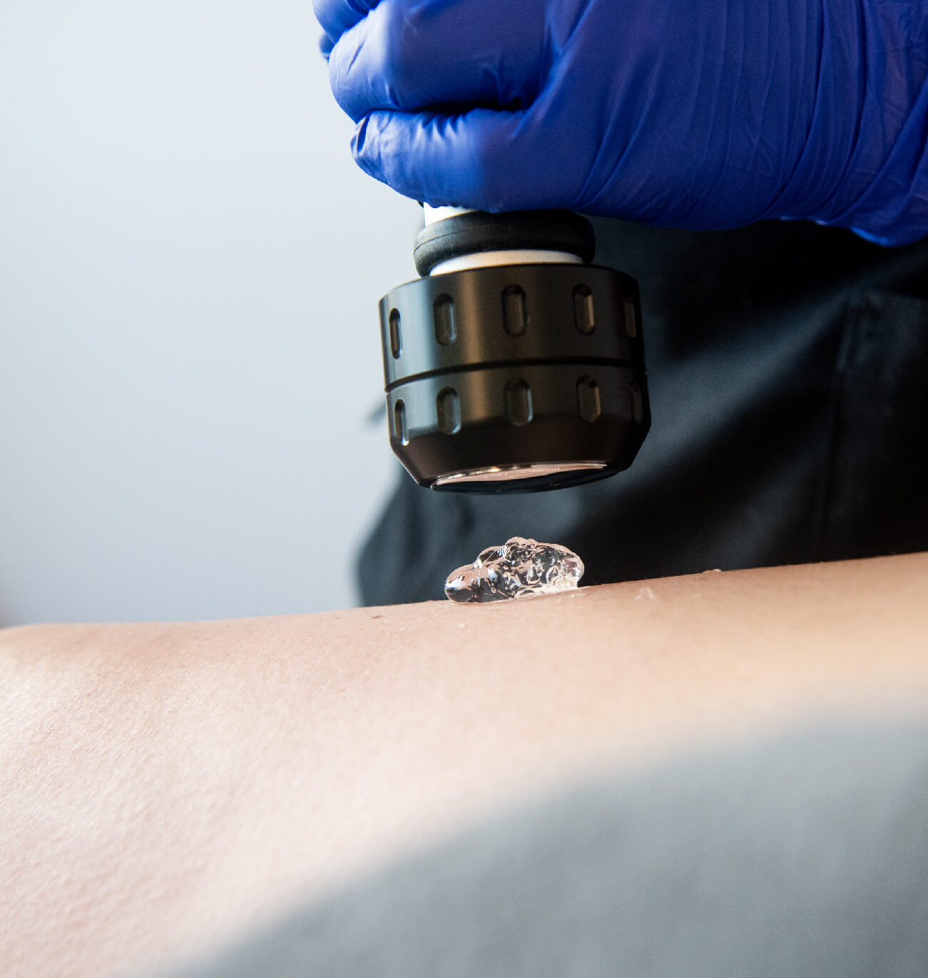 Application du traitement CelluSkin avec un gel conducteur sur la peau, utilisant une technologie innovante pour améliorer la fermeté et lisser la texture cutanée. Un soin non invasif idéal pour réduire l’apparence de la cellulite et tonifier la peau.