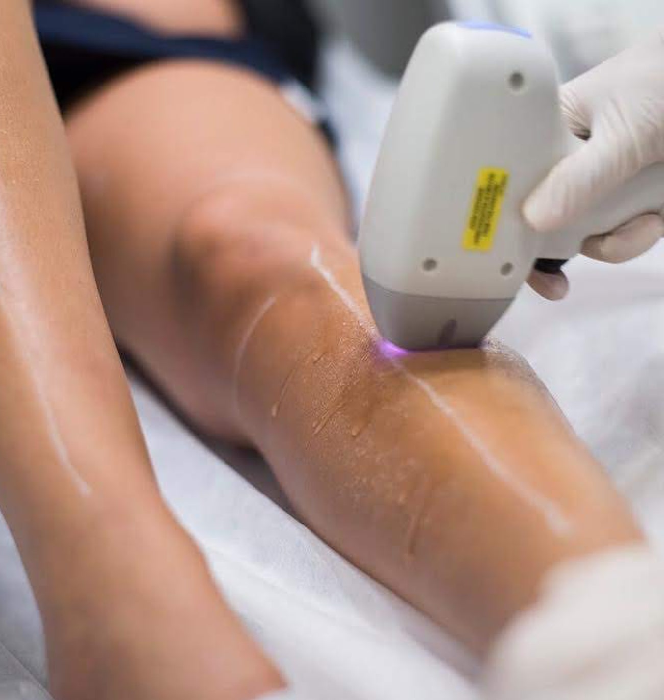 Séance d’épilation définitive au laser sur une jambe, utilisant un appareil de laser pour éliminer les poils indésirables, au sein de la clinique St-Laurent Médico-Esthétique.