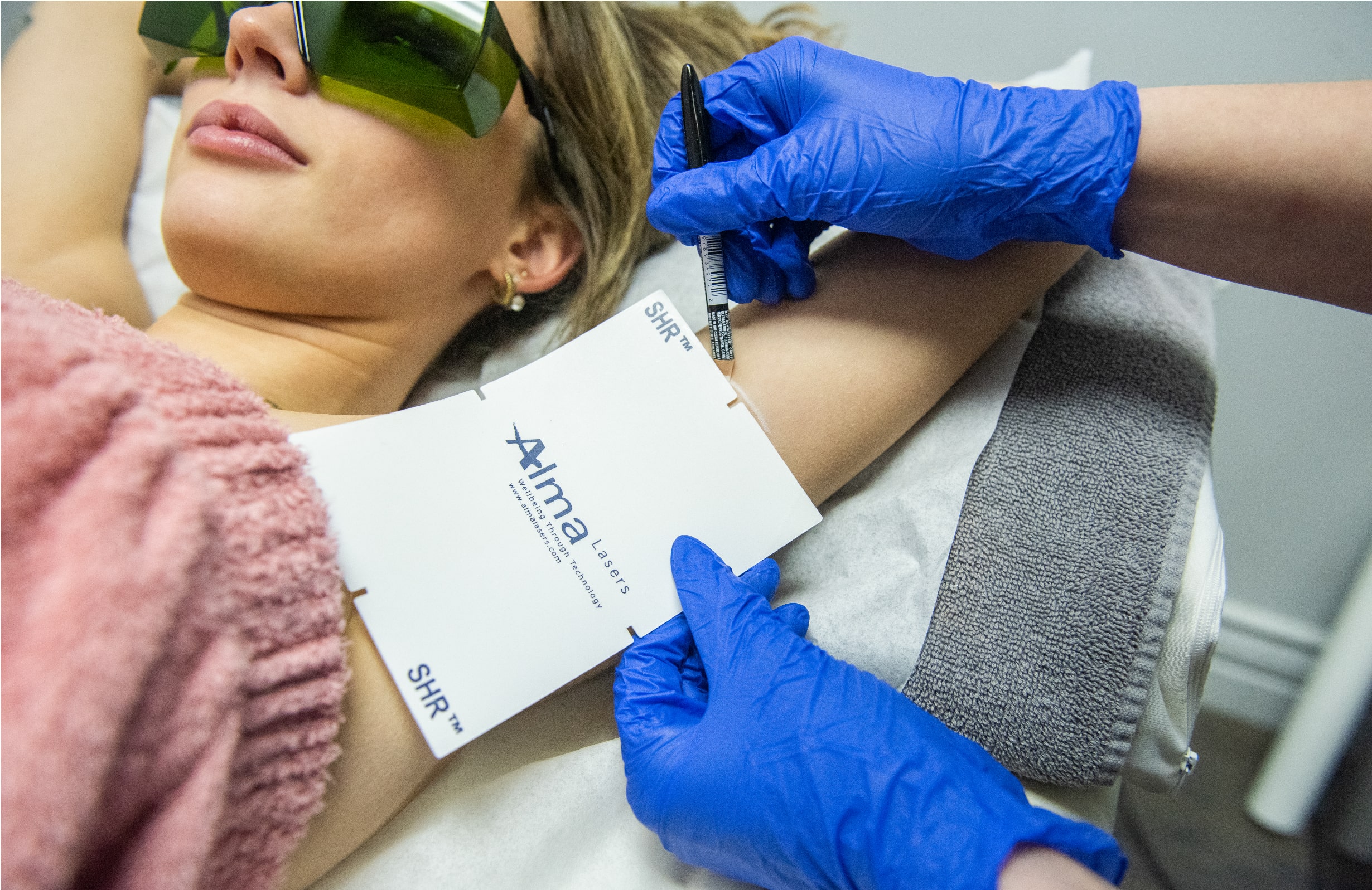 Un professionnel marque la zone à traiter sous les aisselles d'une patiente lors d'une consultation pour un traitement d'épilation laser.