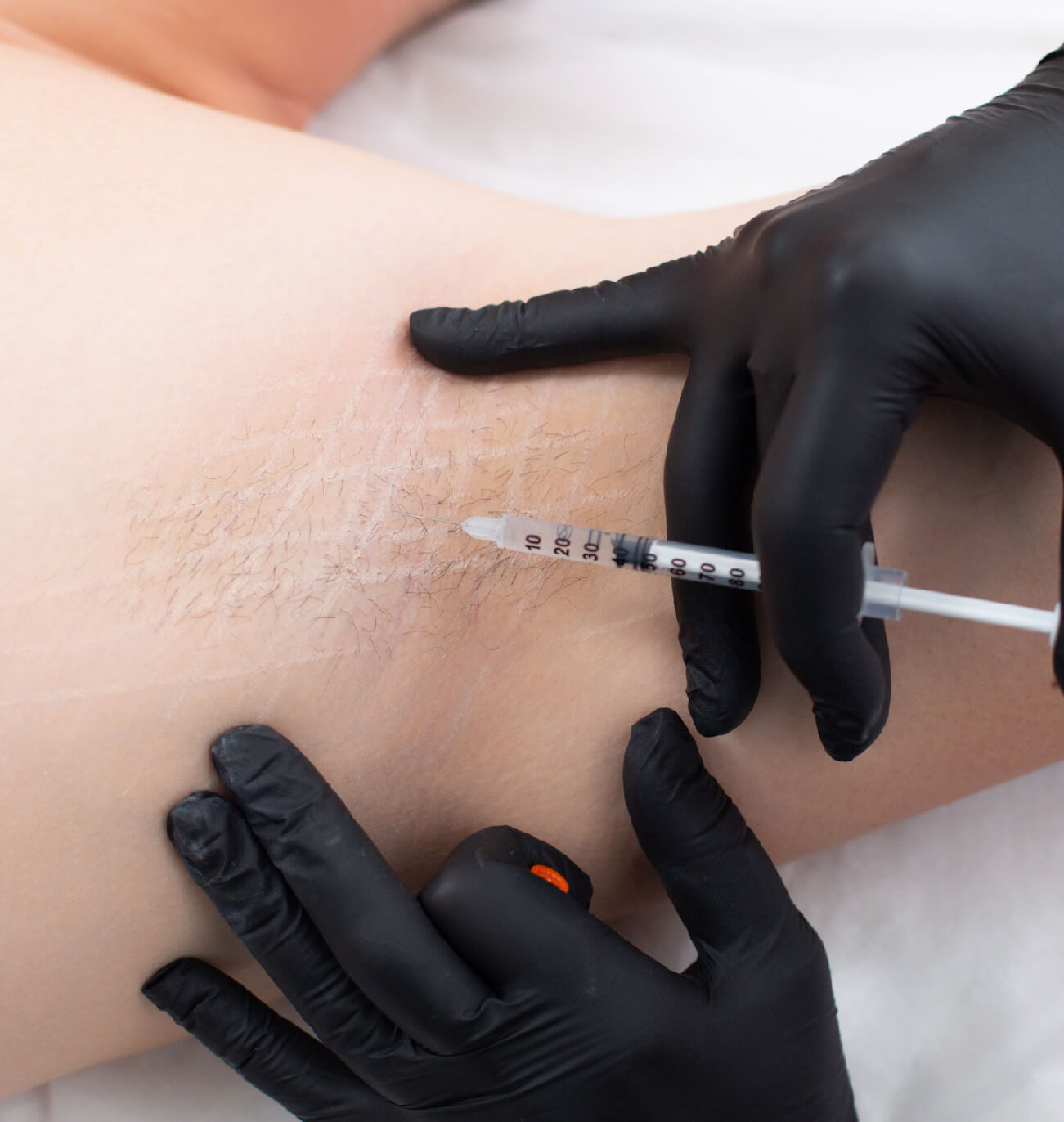 Avantages des injections de l’hyperhidrose : améliore l'hygiène et le confort