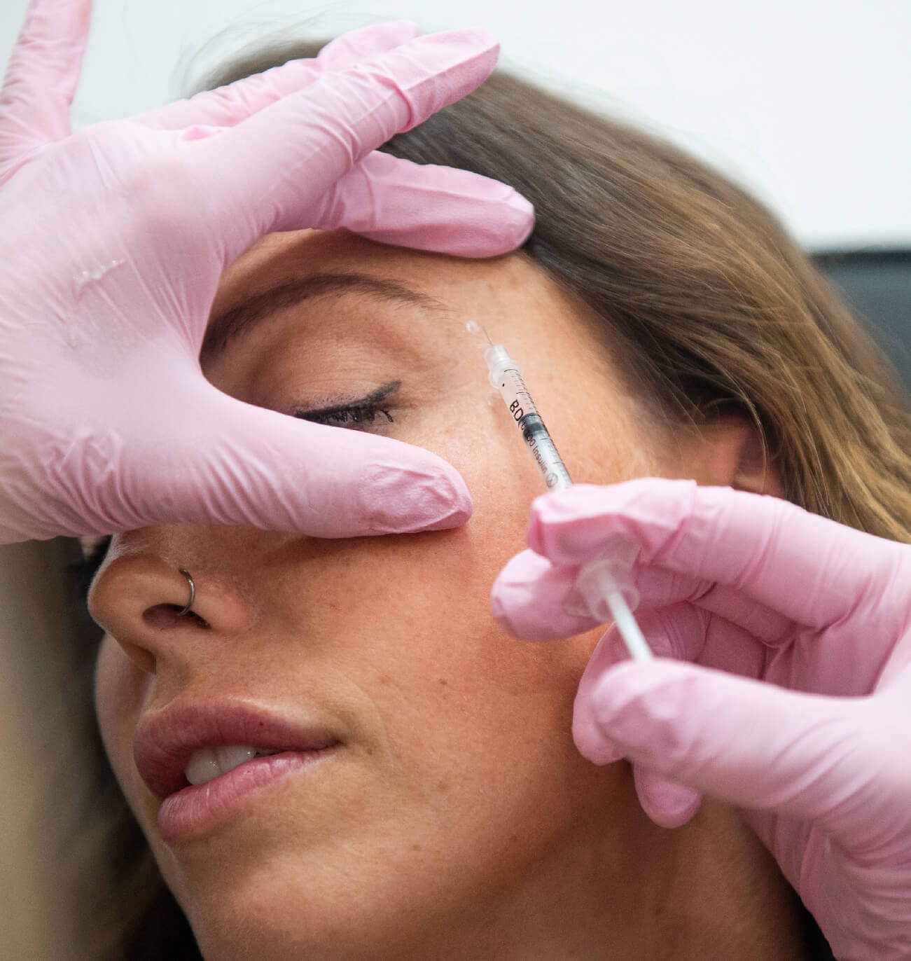 Avantages des injections de neuromodulateurs : réduction des rides d’expression