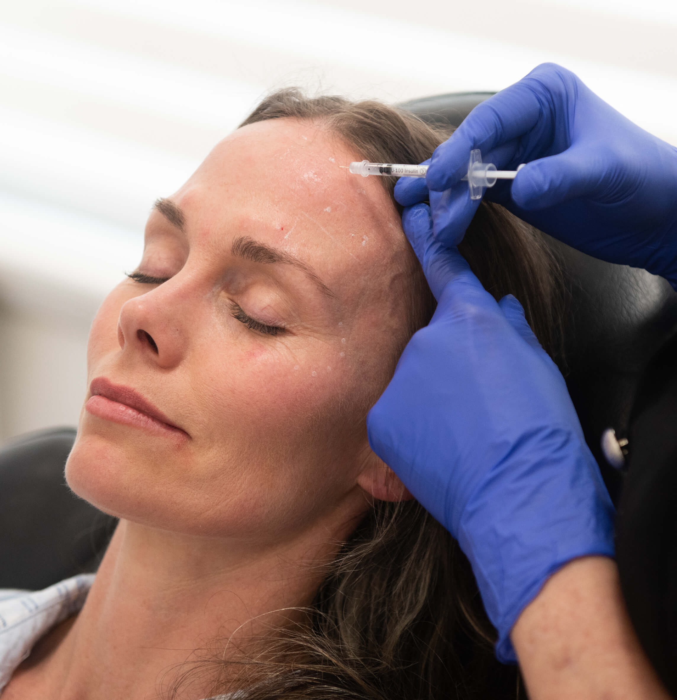 Injection de neuromodulateur pour traiter les rides du front chez une femme