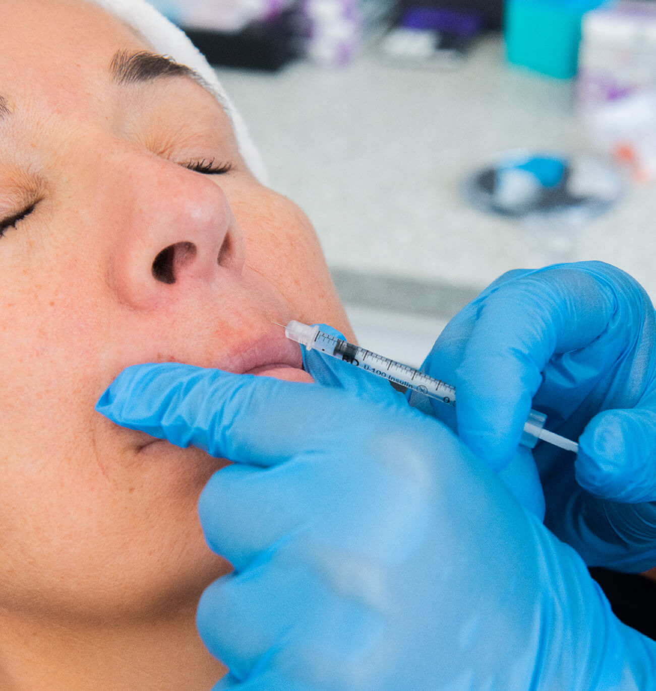 Avantages des injections d’acide hyaluronique : amélioration de la contour des lèvres