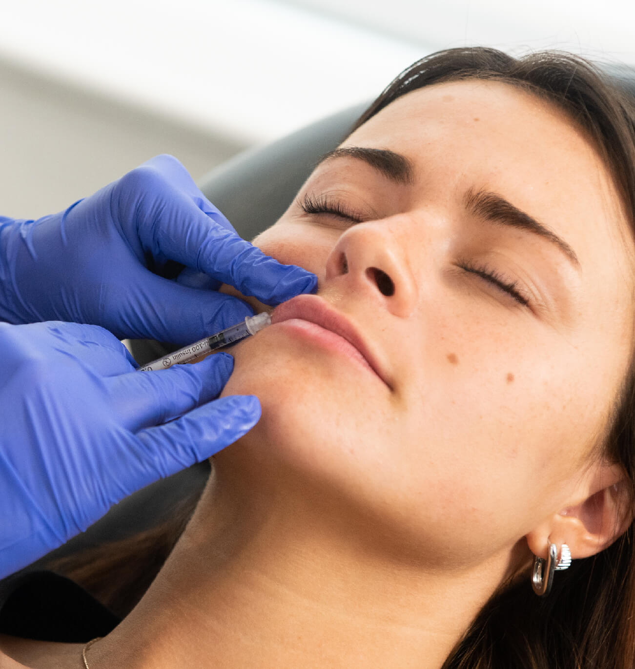 Avantages des injections d’acide hyaluronique : réduction des cernes creux sous les yeux