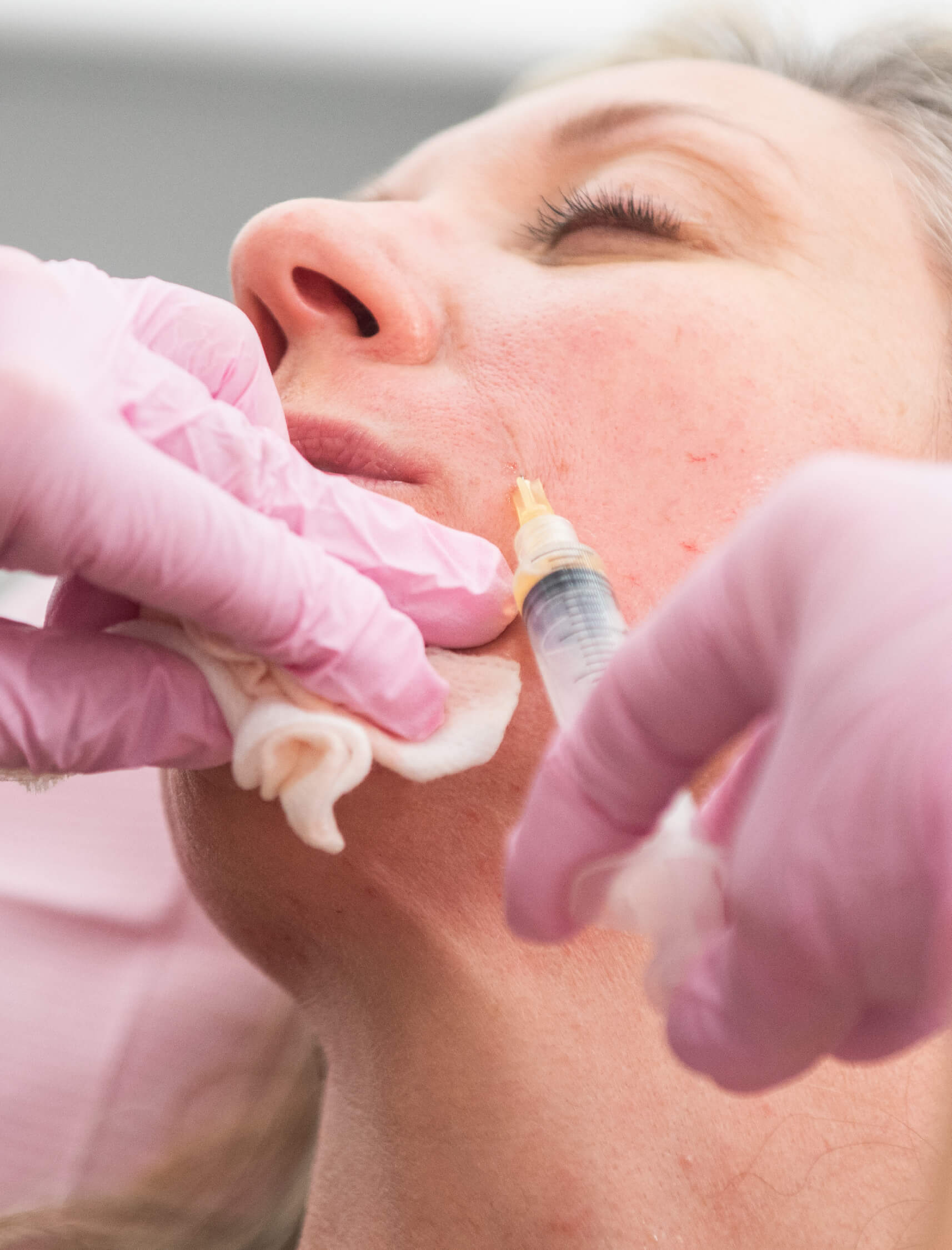 Gros plan sur une injection esthétique ciblée pour réduire les rides et améliorer la texture de la peau, réalisée en clinique spécialisée avec des soins professionnels