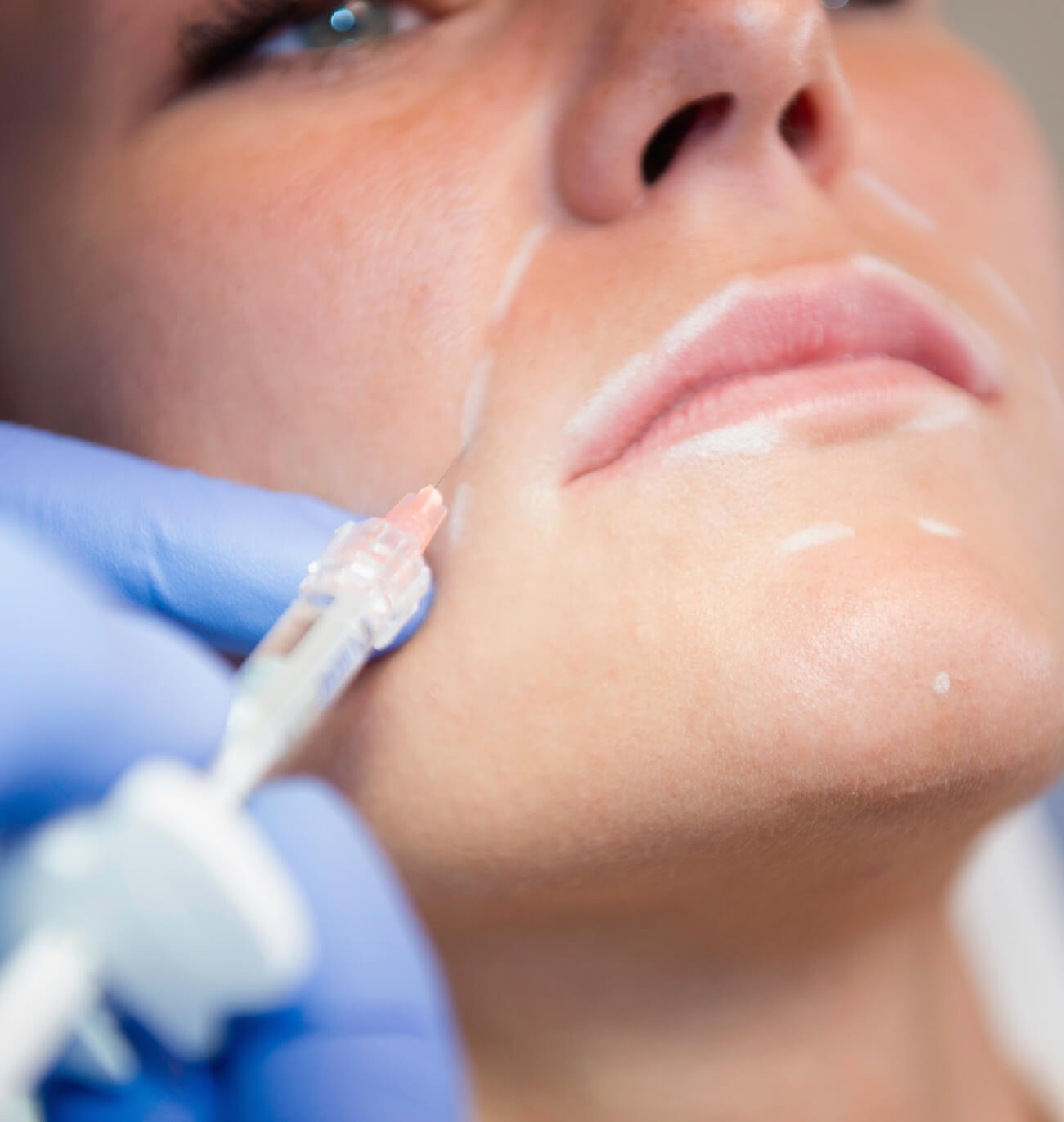Injection esthétique au bas du visage, mise en valeur de la précision du traitement pour raffermir la peau, réduire les rides et améliorer le contour naturel en clinique spécialisée.