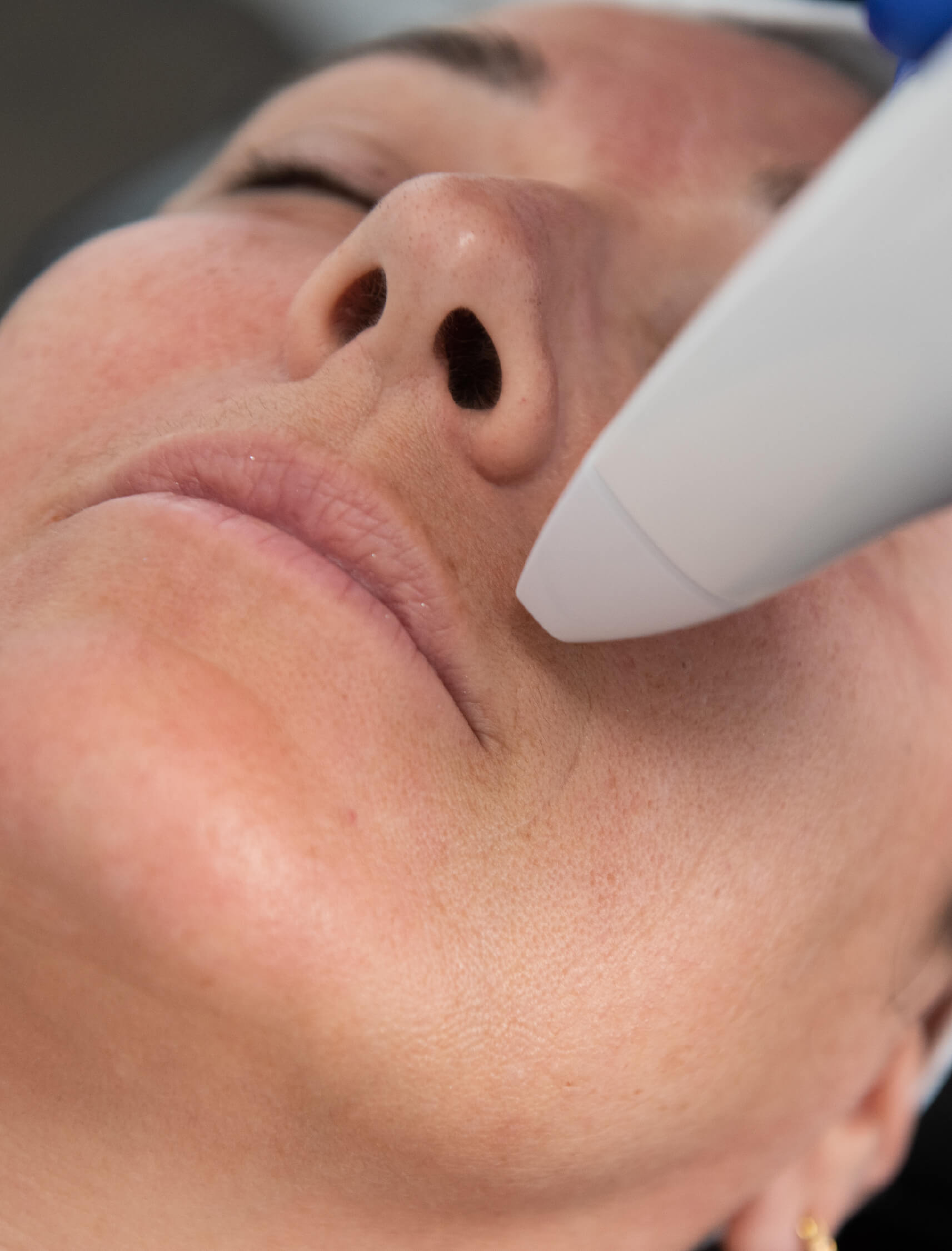 Traitement ciblé Venus Viva sur la zone du visage inférieur pour réduire les rides et améliorer la texture de la peau.