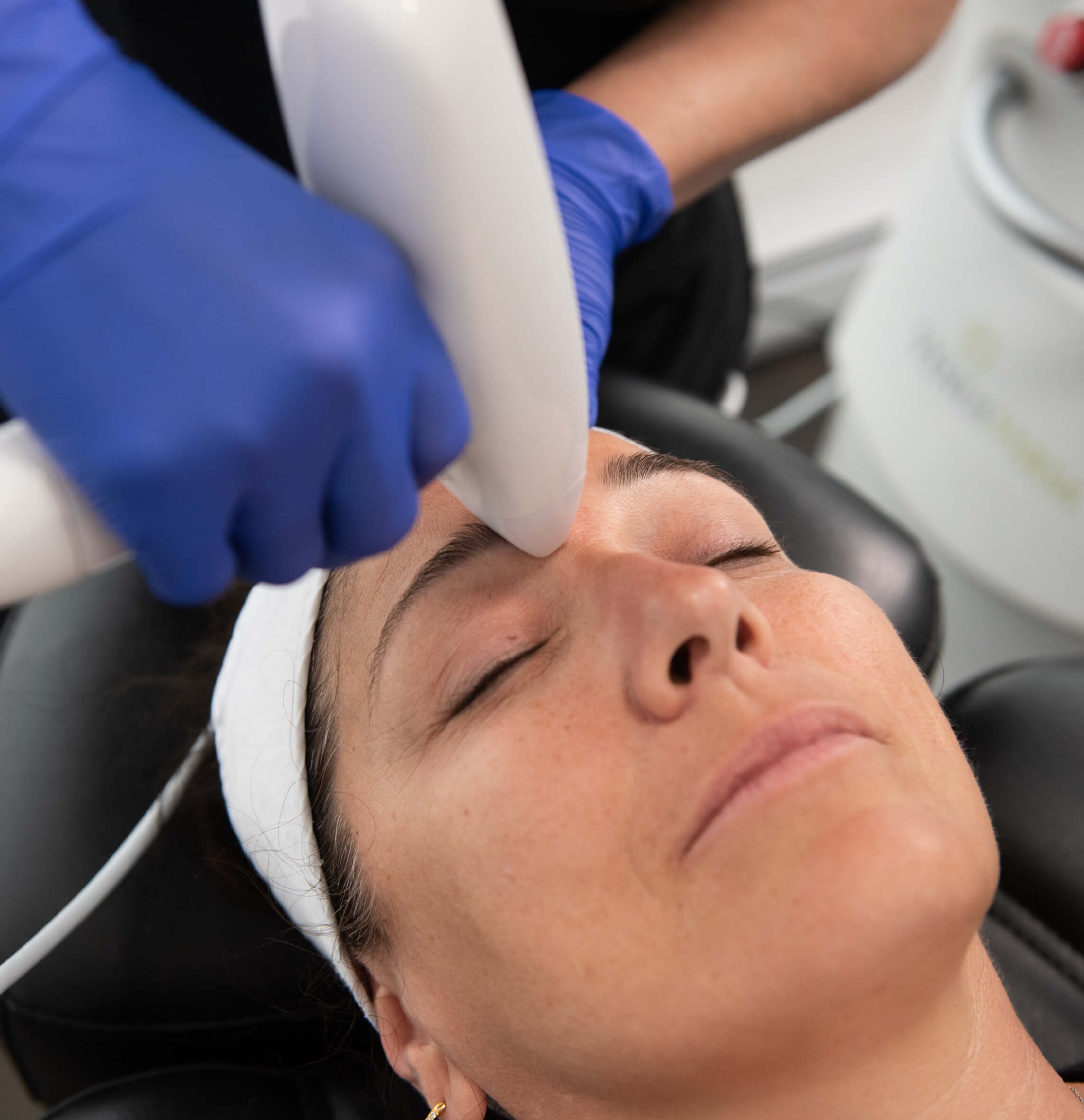Traitement Venus Viva en cours, ciblant le rajeunissement de la peau pour réduire les rides, les cicatrices et améliorer la texture du visage