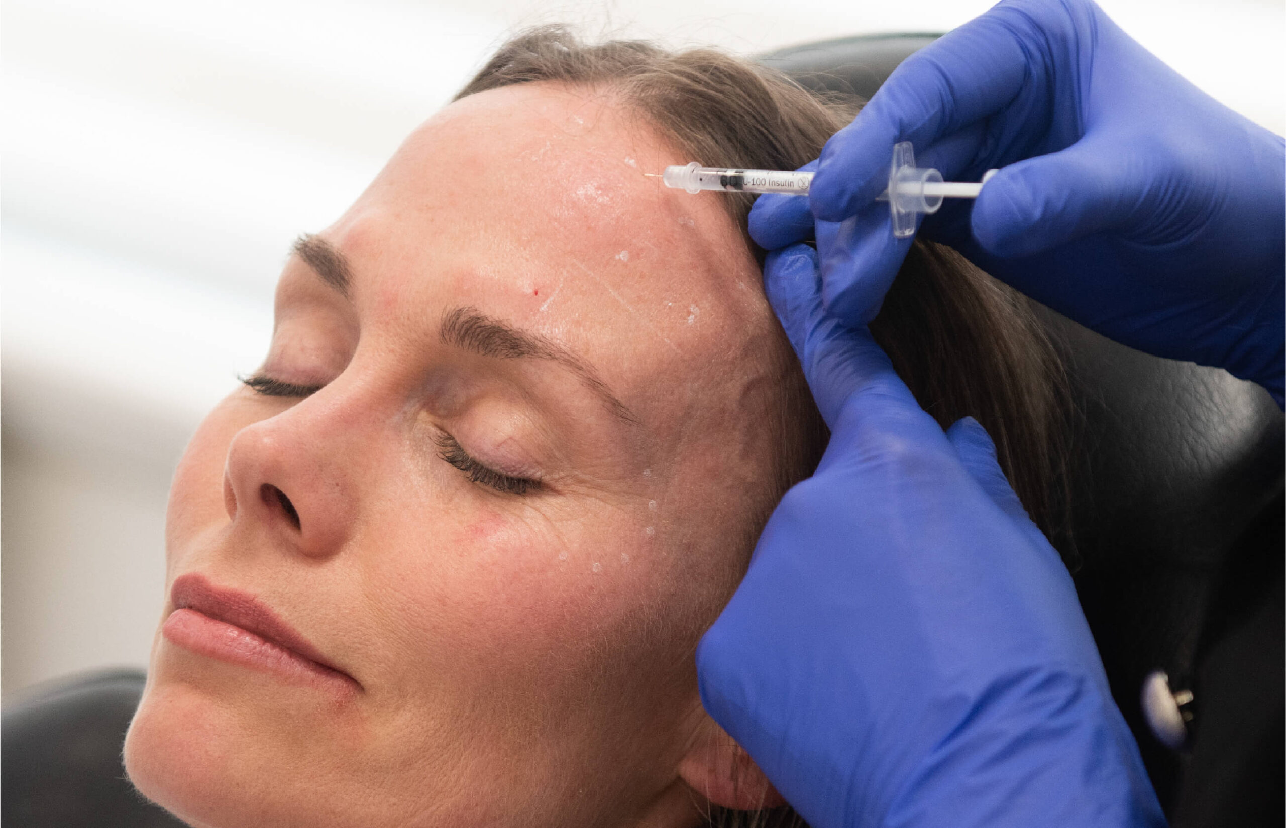 Injection de neuromodulateur pour traiter les rides du front chez une femme
