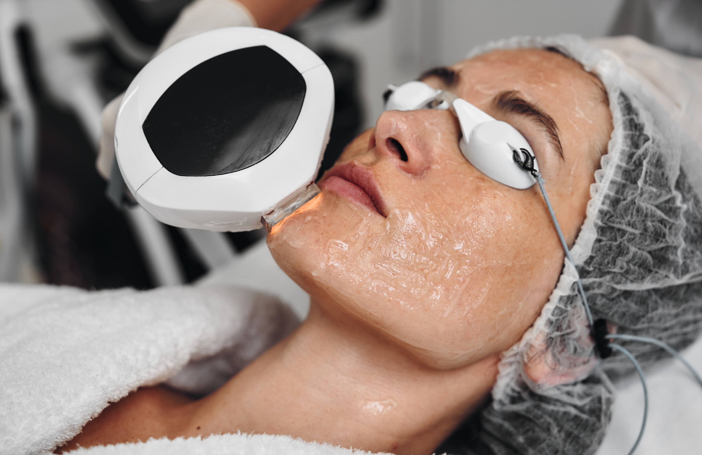 Séance de photorajeunissement IPL pour atténuer les taches pigmentaires et améliorer l’éclat de la peau, réalisée en clinique esthétique