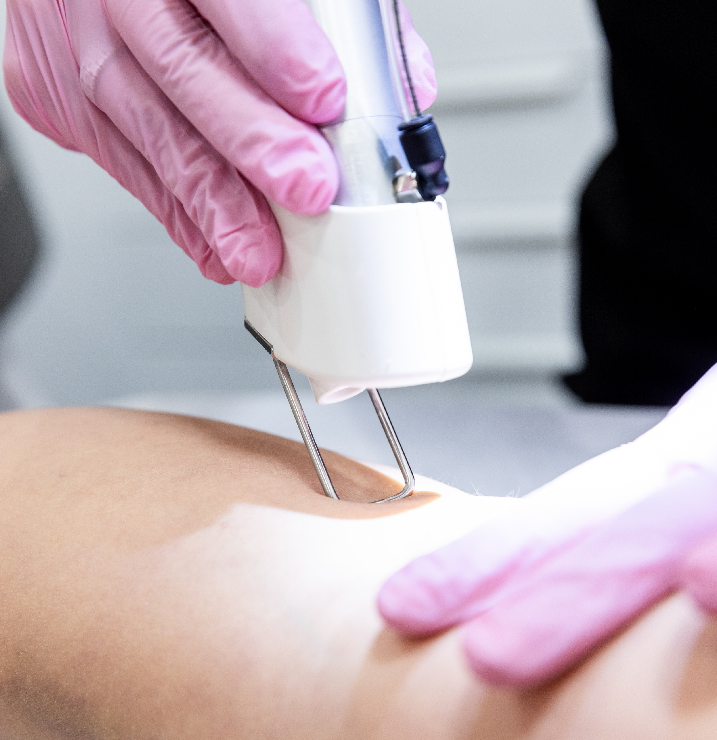 Épilation laser Alexandrite YAG sur une peau nue, effectuée en clinique esthétique pour un résultat durable et efficace