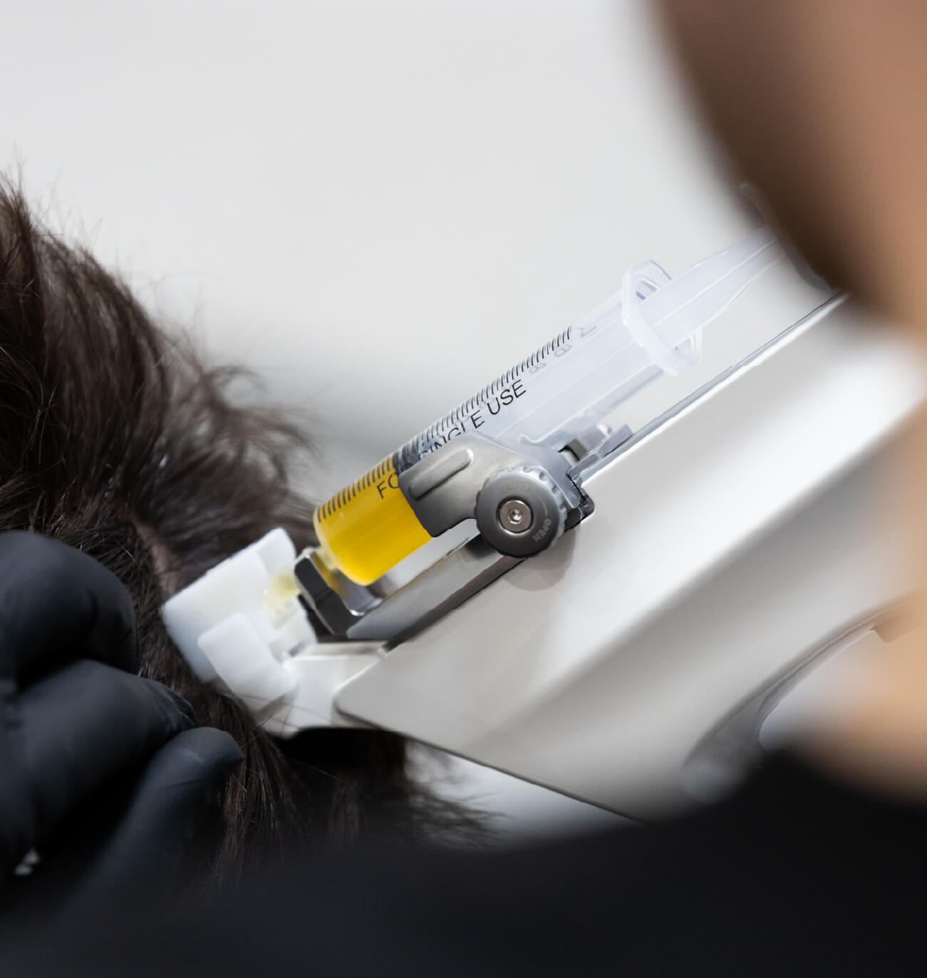 Gros plan sur une seringue de PRP insérée dans un injecteur automatique lors d’un traitement de repousse capillaire.