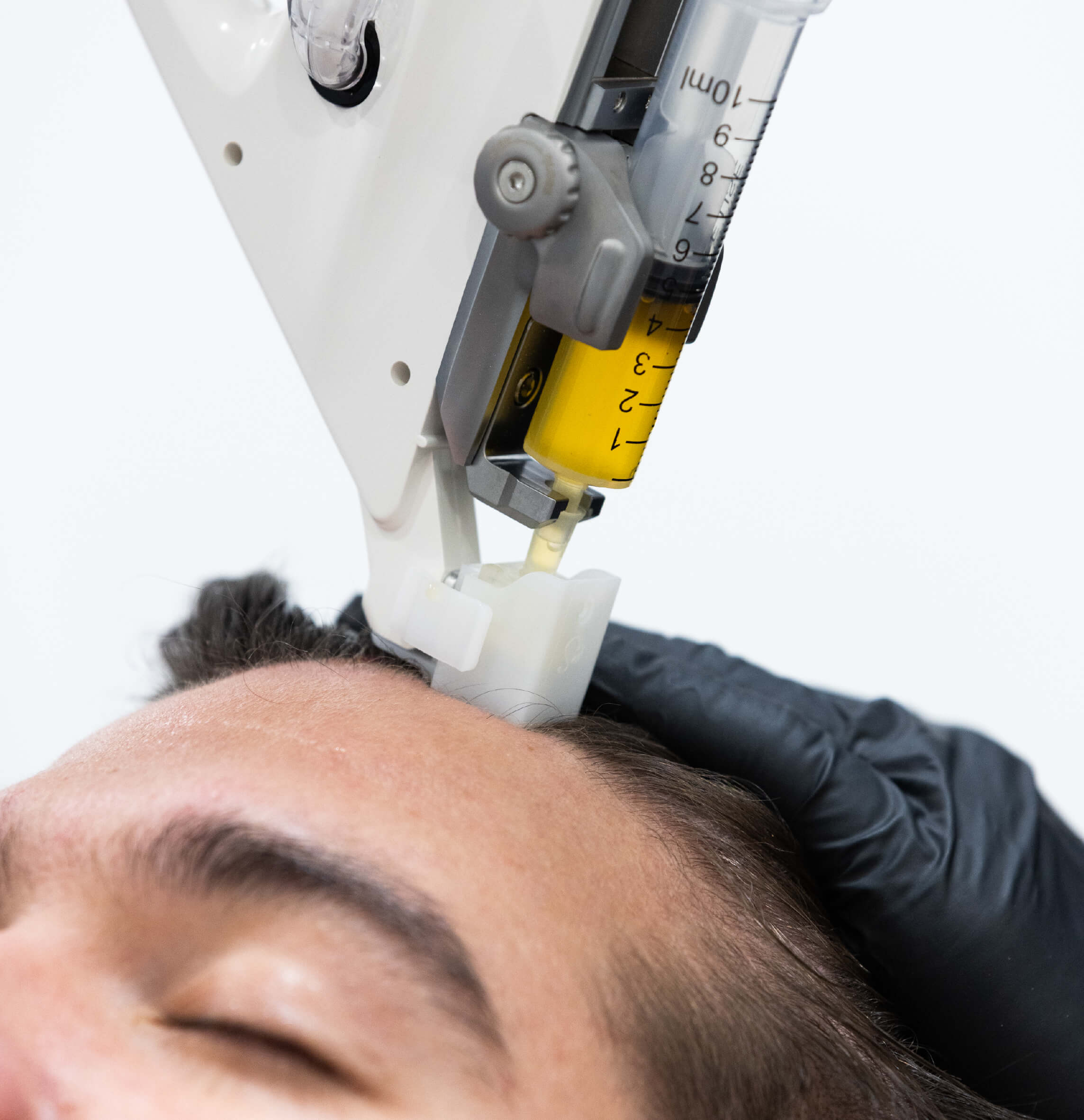 Injection de PRP dans le cuir chevelu à l’aide d’un injecteur automatique pendant un traitement de repousse capillaire.