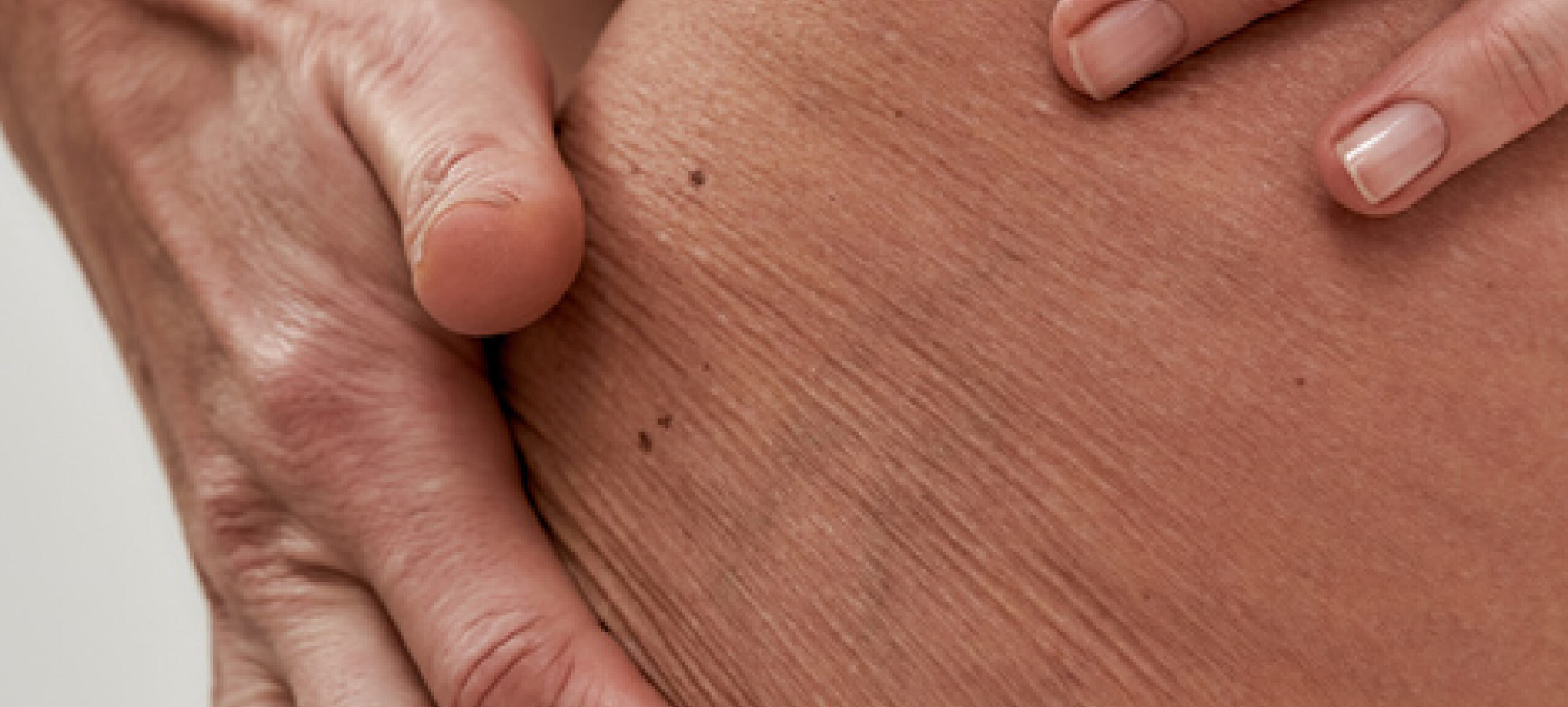 Cellulite : comprendre les types et les meilleures solutions!